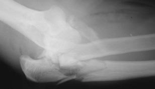 Complex elbow dislocation