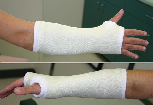 colles fracture cast position