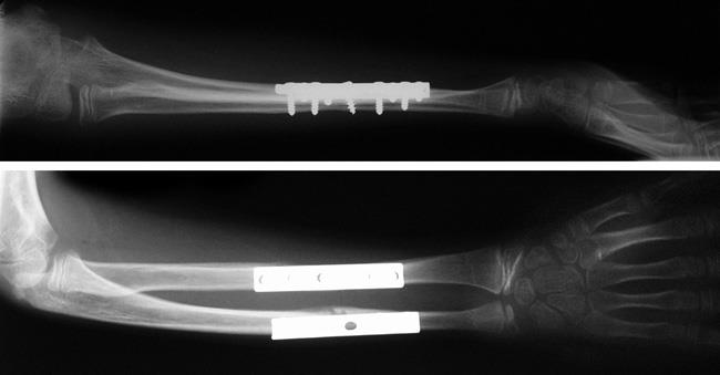 Internal fixation of forearm fractures