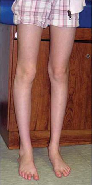 Adolescent with misaligned kneecap