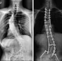 Treatment with spinal fusion