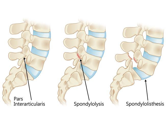 pars defect with spondylolisthesis