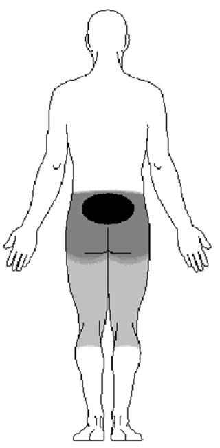 Location of pain from spondylolysis and spondylolisthesis