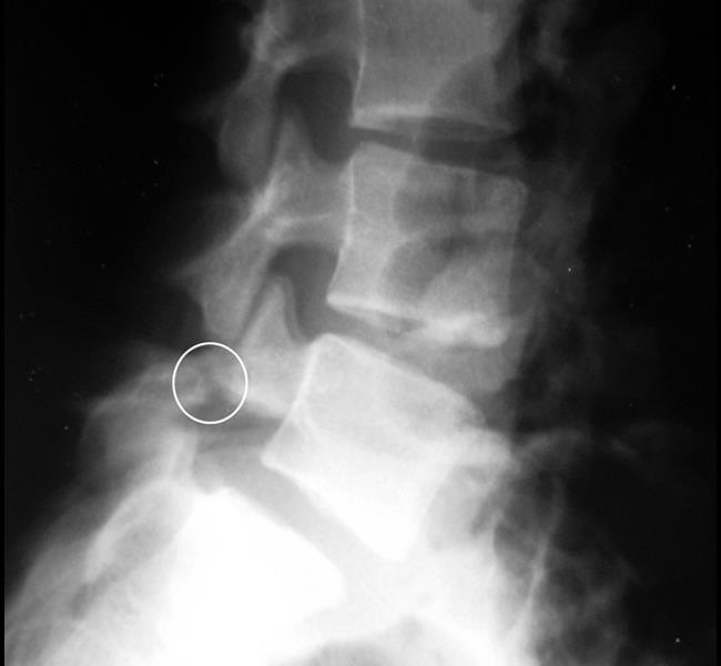 stress fracture in lower back