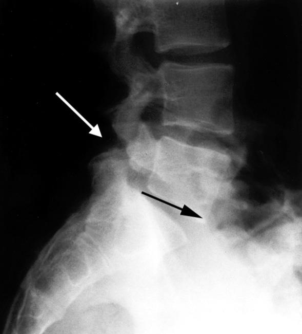 pars defect with spondylolisthesis