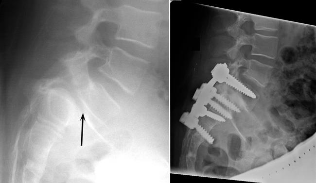 Lumbar Fracture Fixation - Lower Back - Surgery - What We Treat