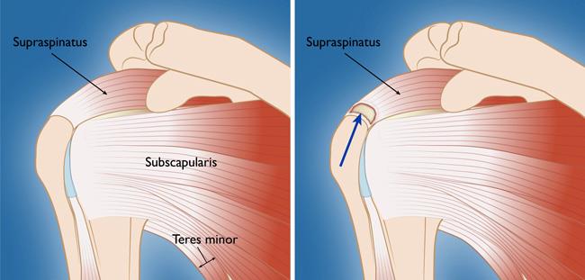 Front view of rotator cuff and full-thickness tear in supraspinatus tendon