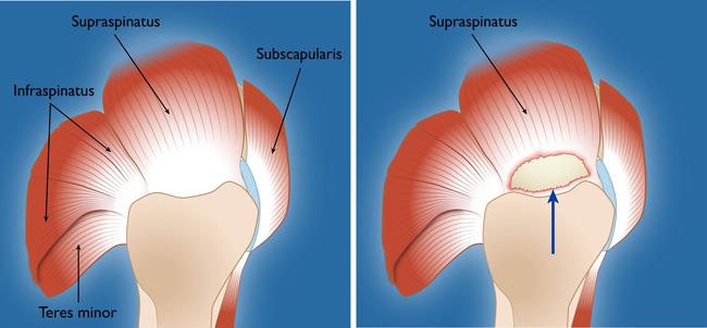 signs and symptoms of torn rotator cuff