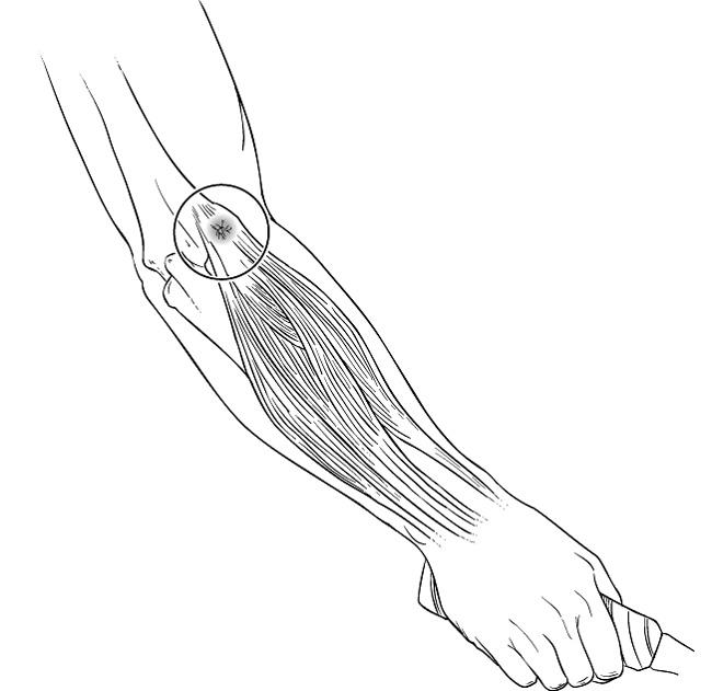 Location of pain in lateral epicondylitis. 