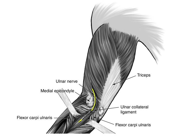 Path of ulnar nerve through cubital tunnel