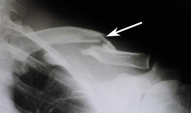 a) X-ray: comminuted fracture of the clavicle with intermediary