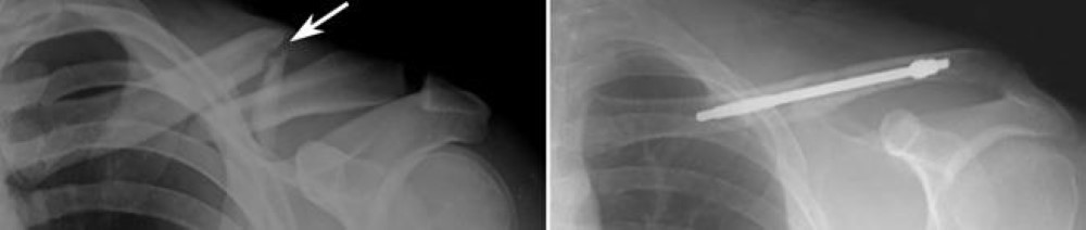 Internal fixation of clavicle fracture