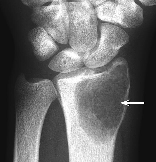 X-ray of giant cell tumor rist