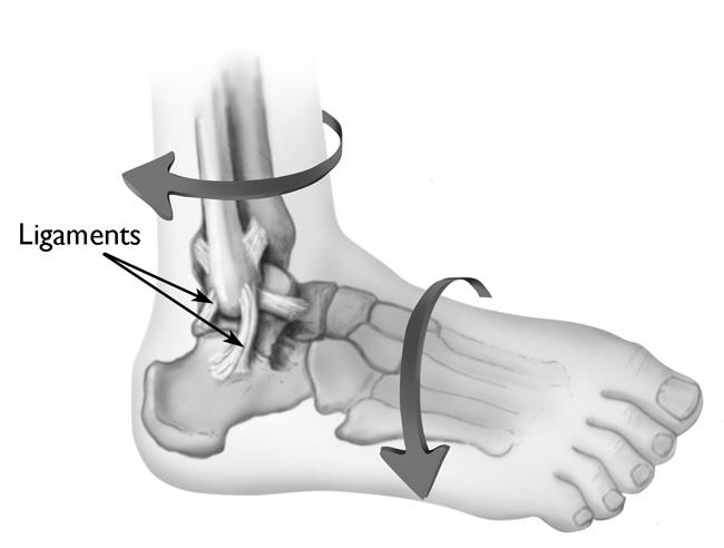 Ankle sprain