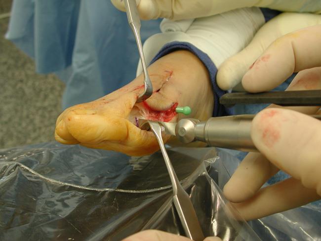 Surgical photo of an osteotomy