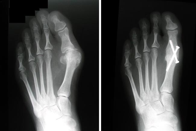 X-rays of an arthritic foot before and after arthrodesis