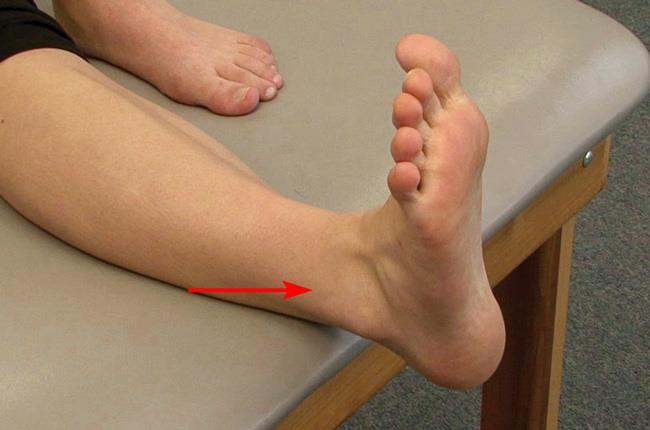 Sprained Ankle - OrthoInfo - AAOS