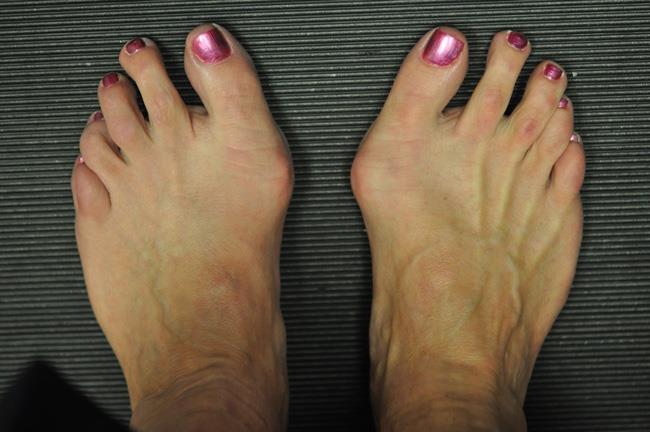This is an image of bunions, the bump on the side of both big toe joints.