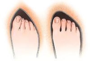 Improper and proper toe box Improper and proper toe box