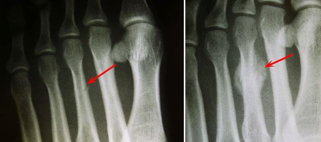 Stress fracture of third metatarsal