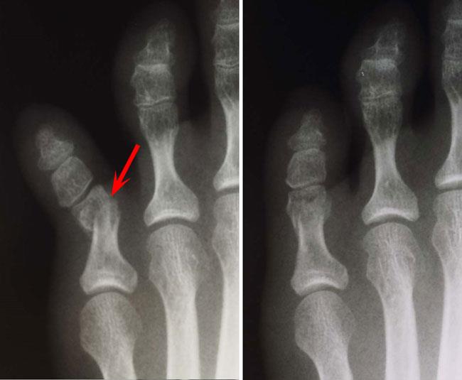 hairline fracture in foot treatment