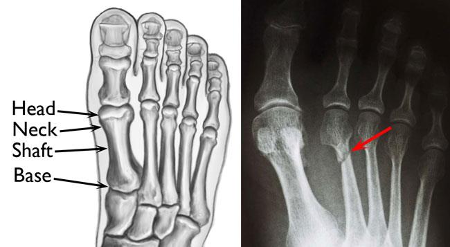 Fracture of the second metatarsal