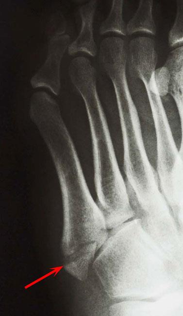 Avulsion fracture of the fifth metatarsal