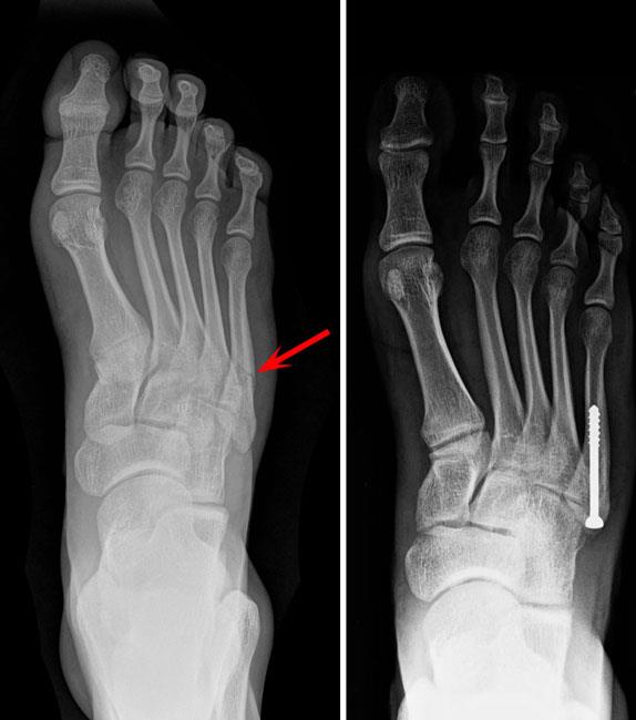 metatarsal fracture healing