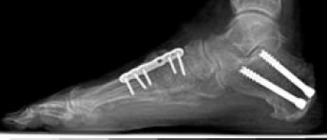 Osteotomy