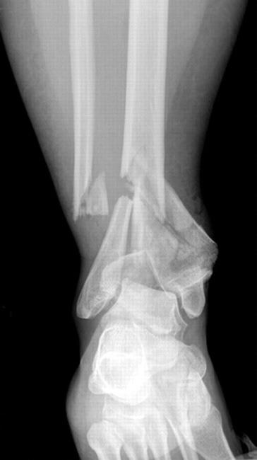 X-ray of broken ankle