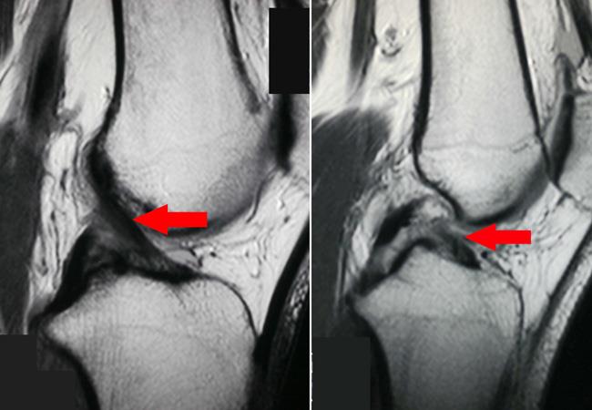 MRI of torn ACL