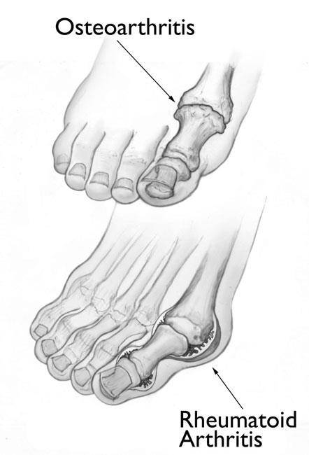 illustrations of osteoarthritis and rheumatoid arthritis of the big toe