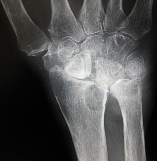 Arthritis of the Wrist - Orthopedic & Sports Medicine
