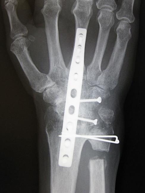 X-ray of complete wrist fusion