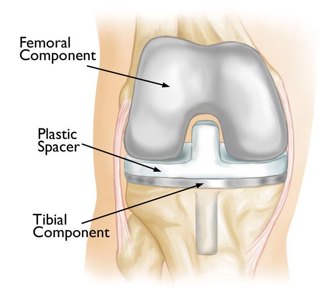 Solved] The contact between femoral and tibia components in knee joint