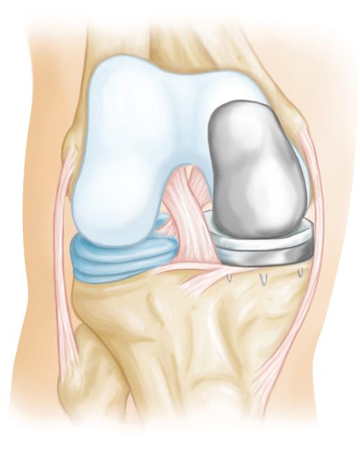 Unicompartmental (partial) knee replacement