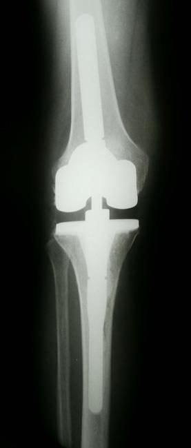 Knee Replacement Implants - OrthoInfo - AAOS