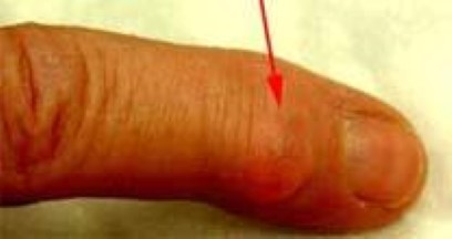 Mucous cyst of the index finger.