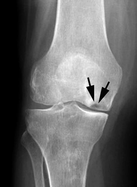 X-ray of osteonecrosis at the lower end of the femur