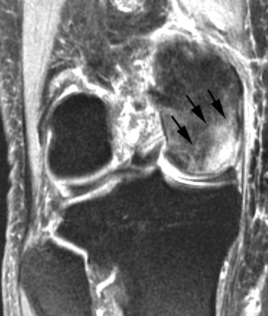 MRI scan of osteonecrosis