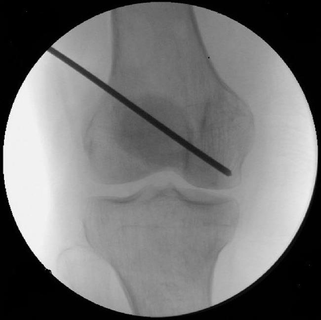 Core decompression on patient with osteonecrosis of the knee