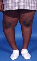An adolescent with Blount's disease