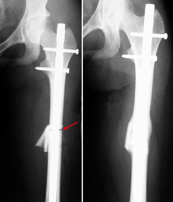 X-rays showing shortening of the femur