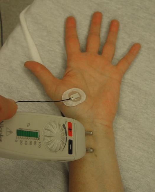 Close up of an EMG being performed with a nerve conduction study. 