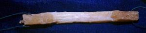Patellar tendon autograft prepared for ACL reconstruction