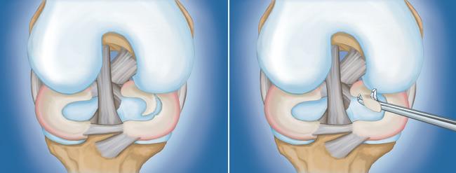 Illustrations of a flap tear and arthroscopic removal of meniscal tissue
