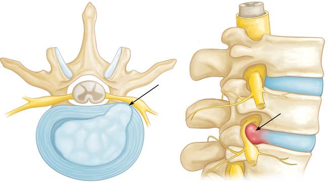 compressed nerve in neck