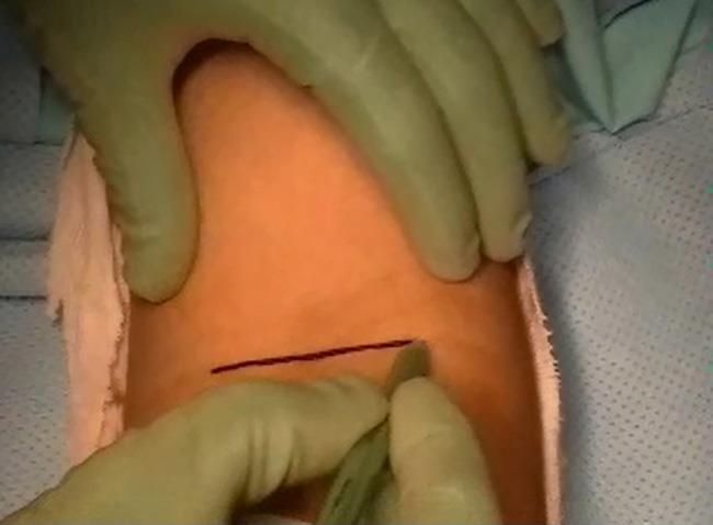 cirugía de incisión única para el tendón del bíceps desgarrado en el codo
