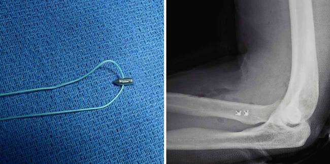 anclajes de sutura utilizados en cirugía para reparar el tendón distal del bíceps desgarrado