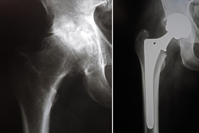 X-rays before and after total hip replacement. 